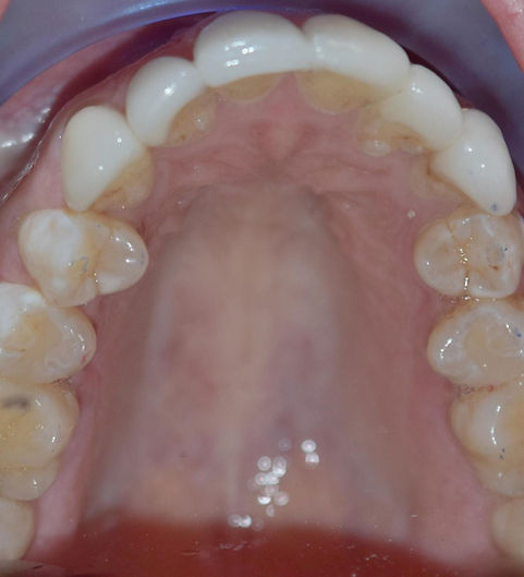 Invisalign-After