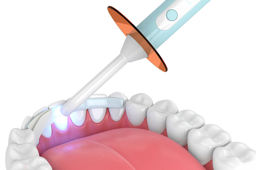 Dental Bonding in Denver