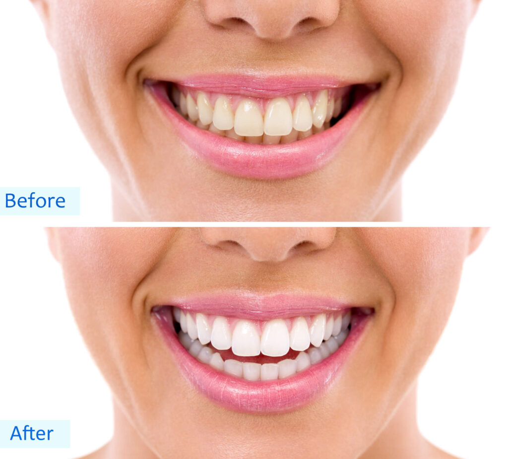 Before and after teeth whitening Denver 