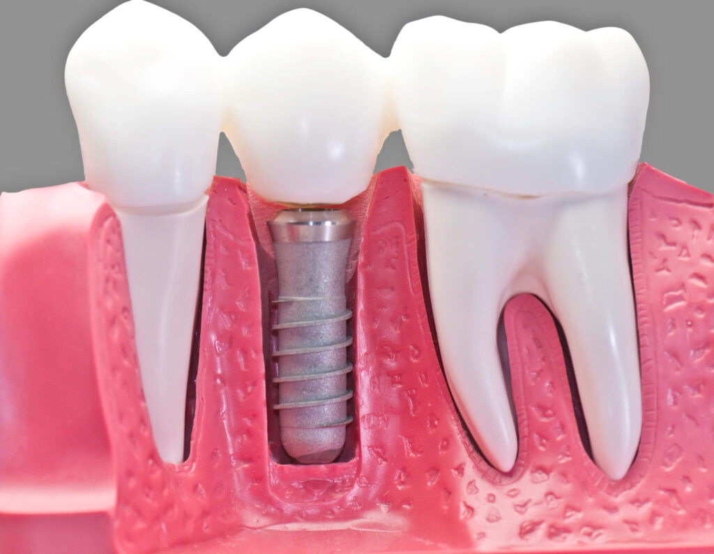 3D render of dental implants in Denver