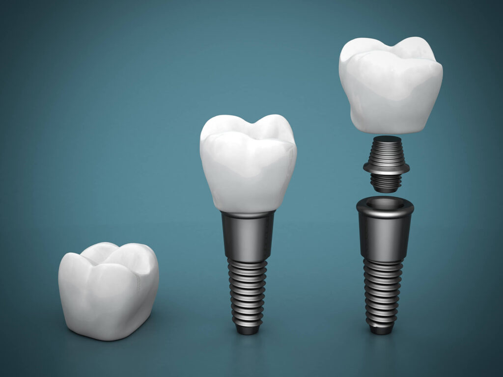 Reasons You Should Choose Dental Implants