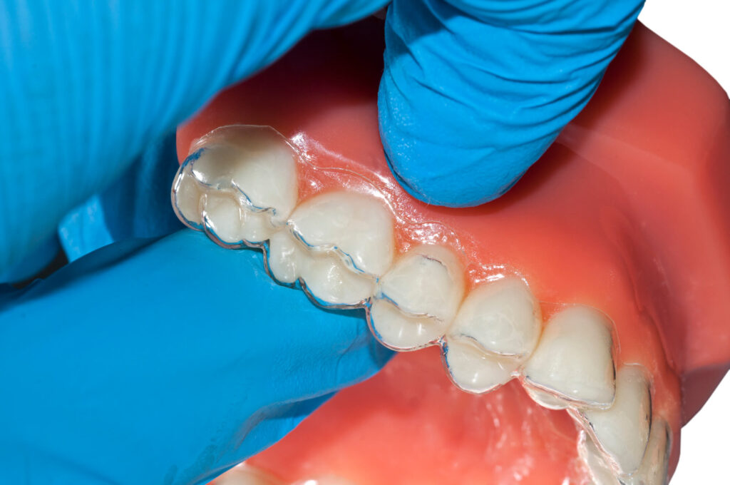 Invisalign placed on teeth in Denver