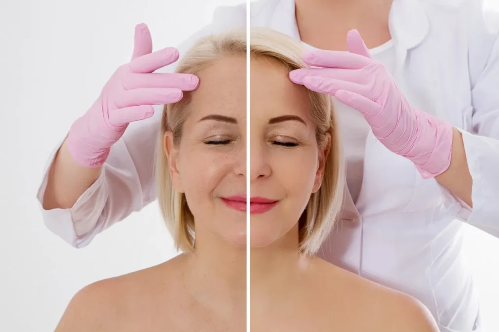 Long-Term Benefits of Preventative Botox and Filler Treatments