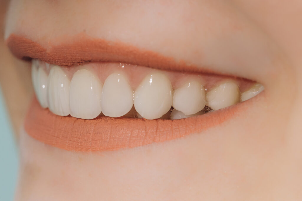 More Than a Smile: Icon Dental’s Patient-Centric Approach to Cosmetic Veneers