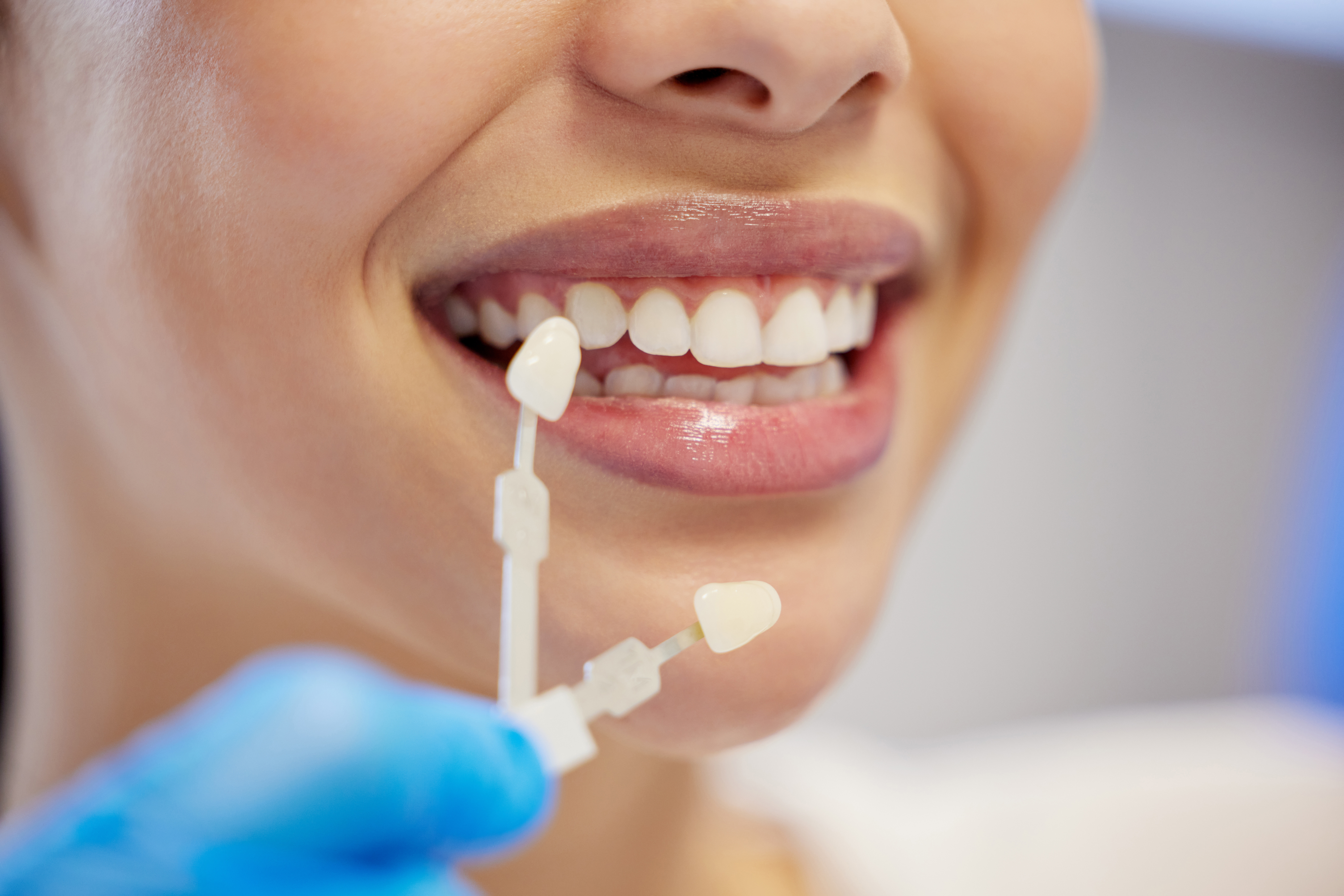 The Ultimate Guide to Cosmetic Veneer Longevity: How to Care for Your Dental Veneers in Denver